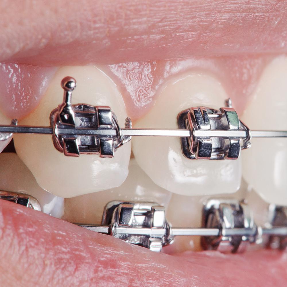 Recupero Metalli Preziosi Settore Dentale